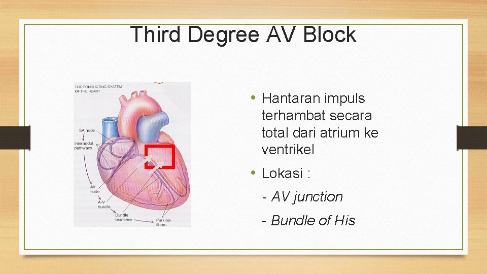 Third Degree AV Block • Hantaran impuls terhambat secara total dari atrium ke ventrikel