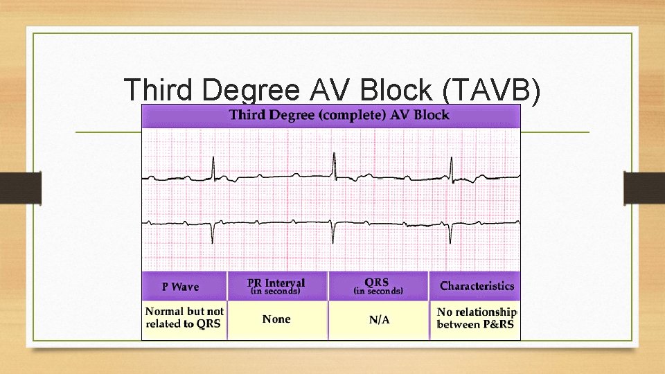 Third Degree AV Block (TAVB) 