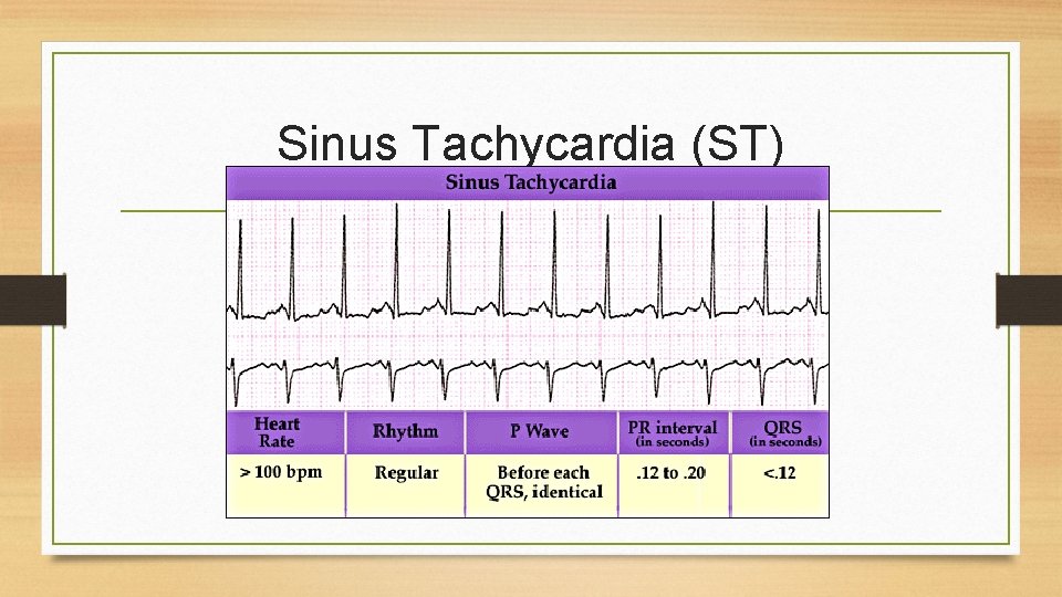 Sinus Tachycardia (ST) 