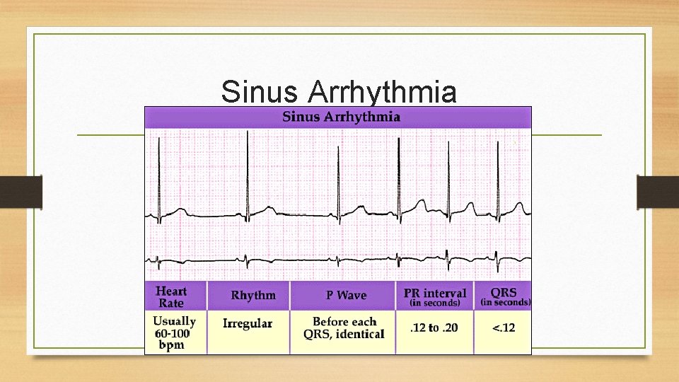 Sinus Arrhythmia 