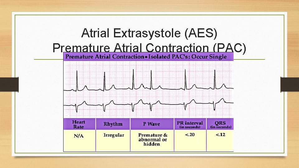 Atrial Extrasystole (AES) Premature Atrial Contraction (PAC) 