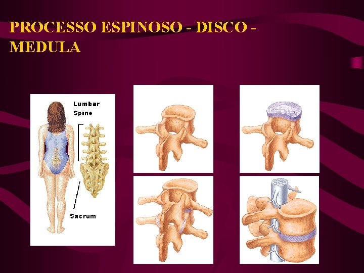 PROCESSO ESPINOSO - DISCO MEDULA 
