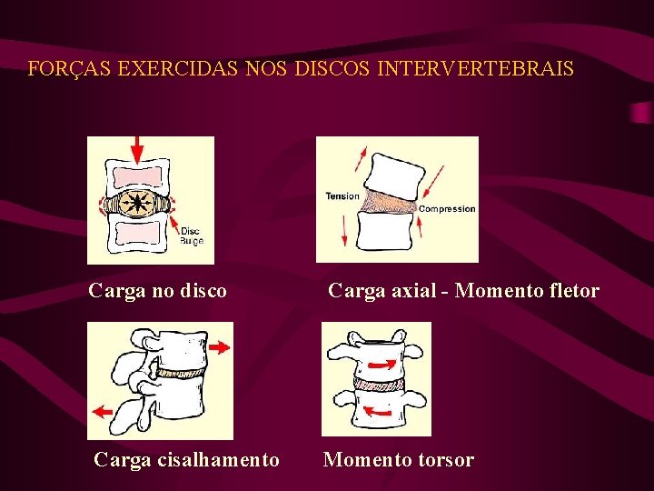 FORÇAS EXERCIDAS NOS DISCOS INTERVERTEBRAIS Carga no disco Carga axial - Momento fletor Carga