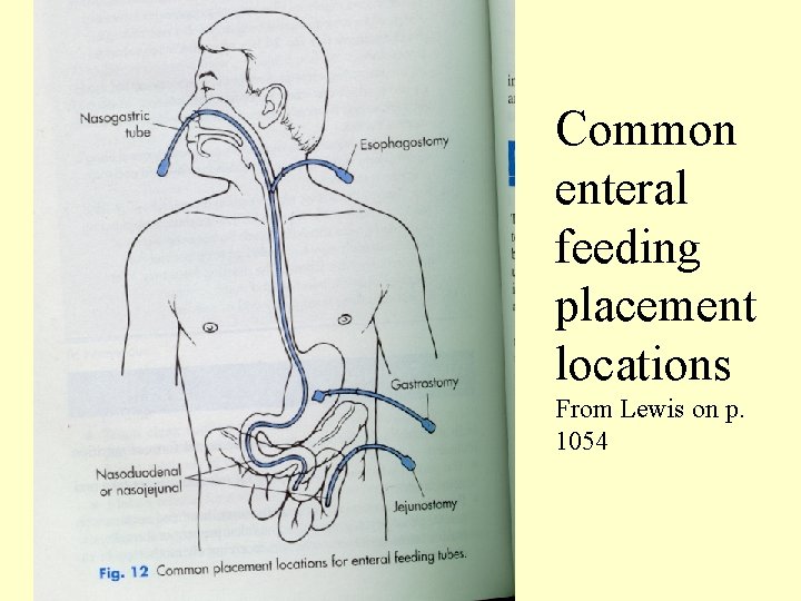 Common enteral feeding placement locations From Lewis on p. 1054 