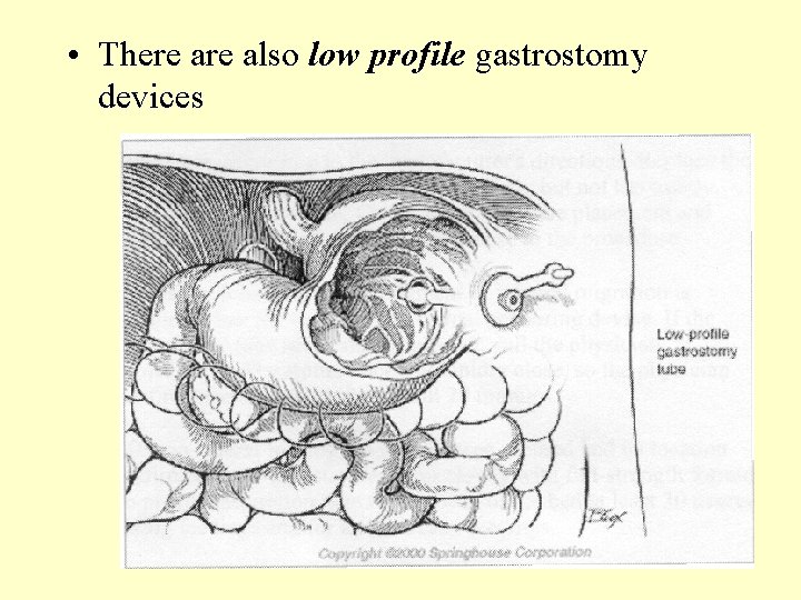  • There also low profile gastrostomy devices 