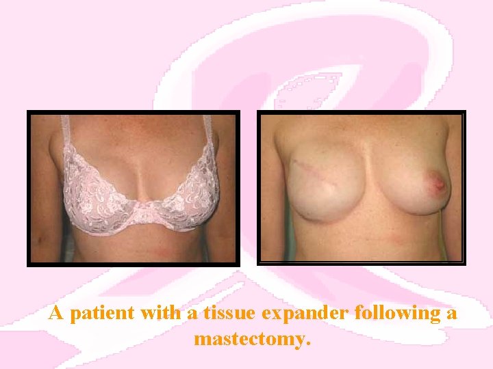 A patient with a tissue expander following a mastectomy. 
