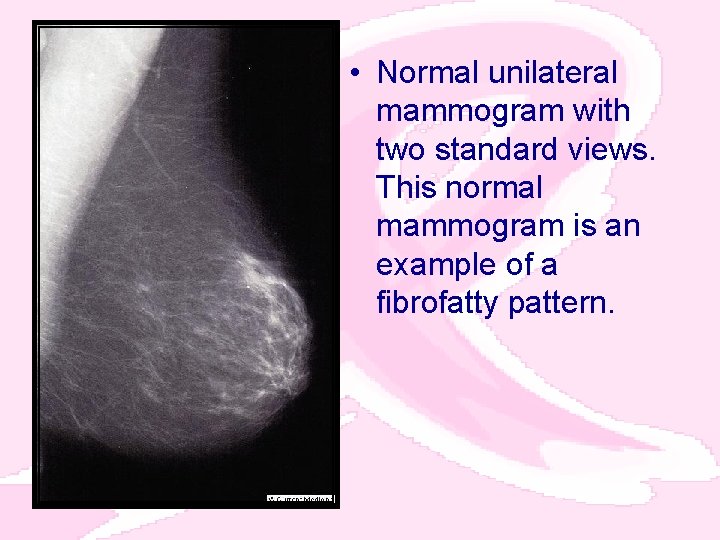  • Normal unilateral mammogram with two standard views. This normal mammogram is an