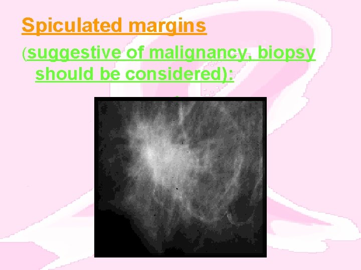 Spiculated margins (suggestive of malignancy, biopsy should be considered): • 