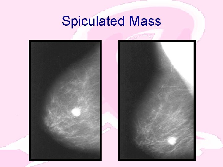 Spiculated Mass 