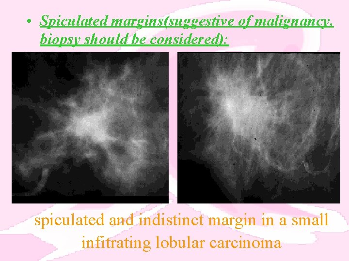  • Spiculated margins(suggestive of malignancy, biopsy should be considered): spiculated and indistinct margin