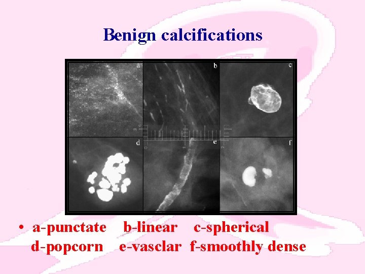 Benign calcifications • a-punctate b-linear c-spherical d-popcorn e-vasclar f-smoothly dense 