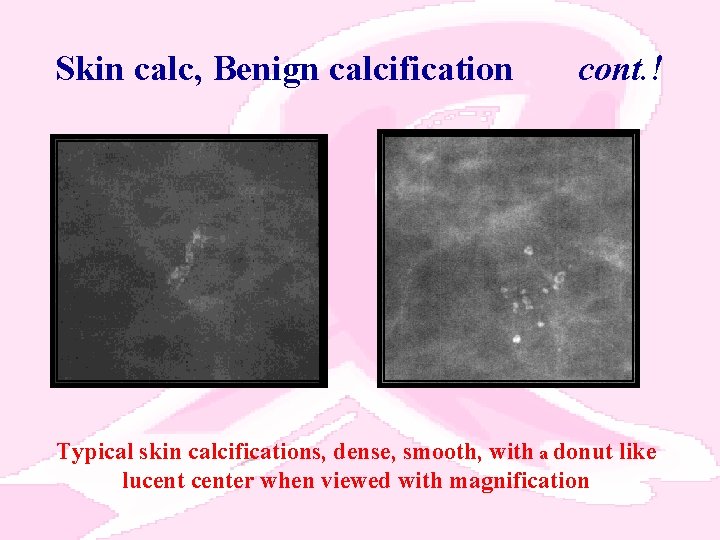 Skin calc, Benign calcification cont. ! Typical skin calcifications, dense, smooth, with a donut