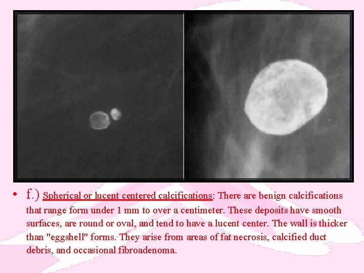  • f. ) Spherical or lucentered calcifications: There are benign calcifications that range
