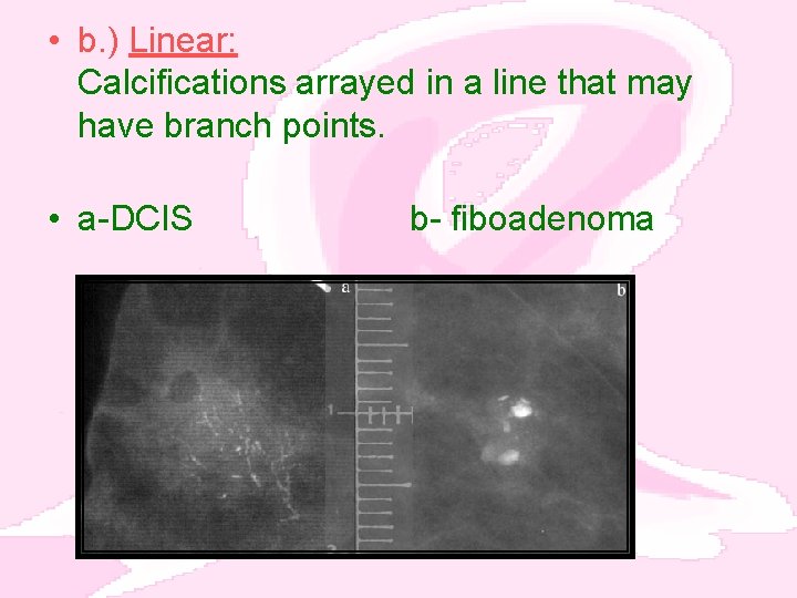  • b. ) Linear: Calcifications arrayed in a line that may have branch