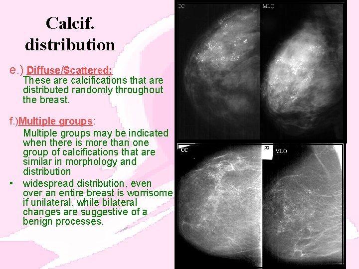 Calcif. distribution e. ) Diffuse/Scattered: These are calcifications that are distributed randomly throughout the
