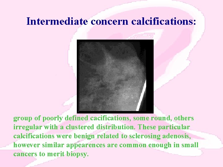Intermediate concern calcifications: group of poorly defined cacifications, some round, others irregular with a