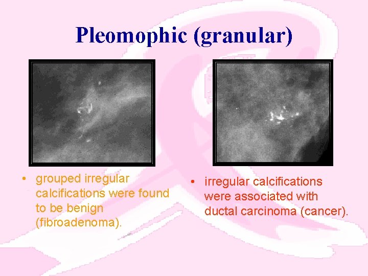 Pleomophic (granular) • grouped irregular calcifications were found to be benign (fibroadenoma). • irregular