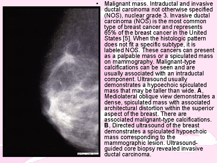  • Malignant mass. Intraductal and invasive ductal carcinoma not otherwise specified (NOS), nuclear