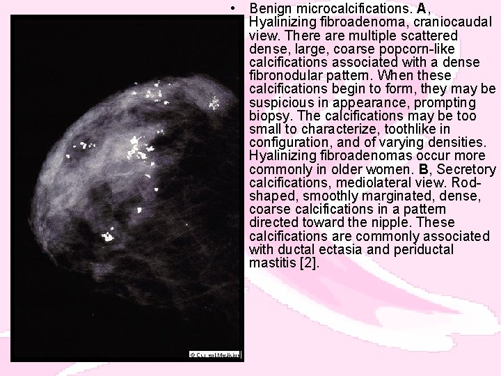  • Benign microcalcifications. A, Hyalinizing fibroadenoma, craniocaudal view. There are multiple scattered dense,
