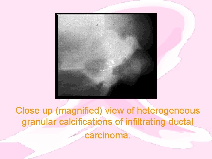 Close up (magnified) view of heterogeneous granular calcifications of infiltrating ductal carcinoma. 