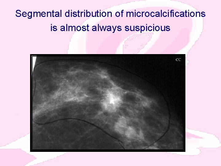 Segmental distribution of microcalcifications is almost always suspicious 