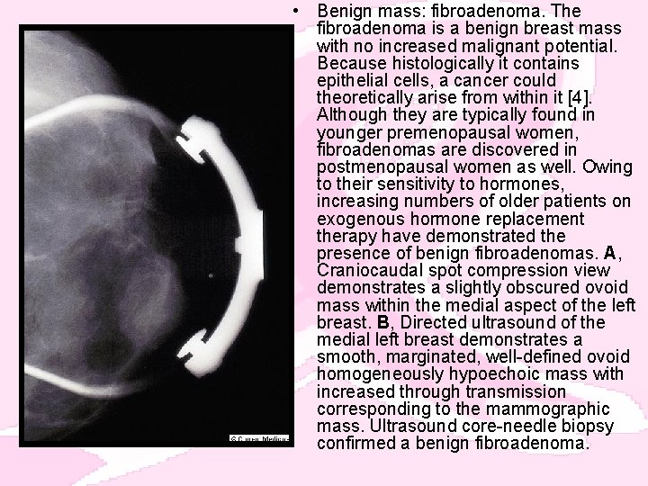  • Benign mass: fibroadenoma. The fibroadenoma is a benign breast mass with no