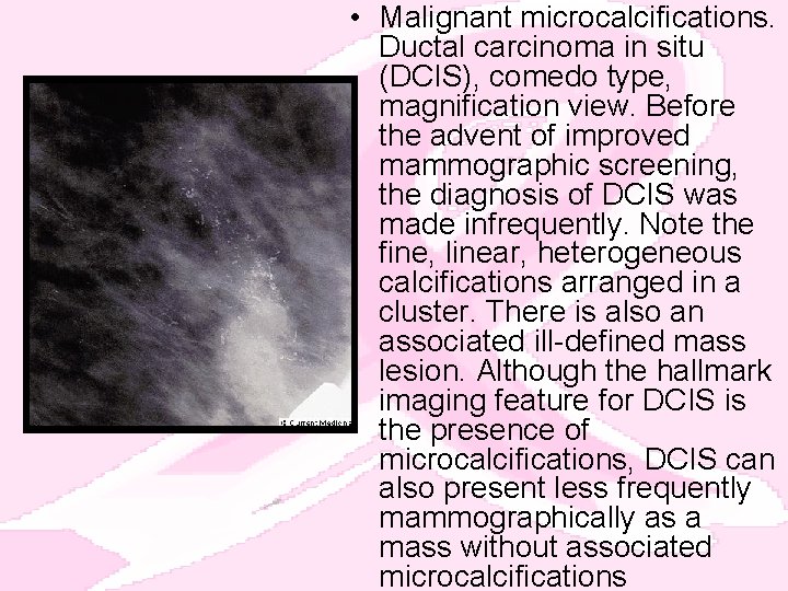  • Malignant microcalcifications. Ductal carcinoma in situ (DCIS), comedo type, magnification view. Before