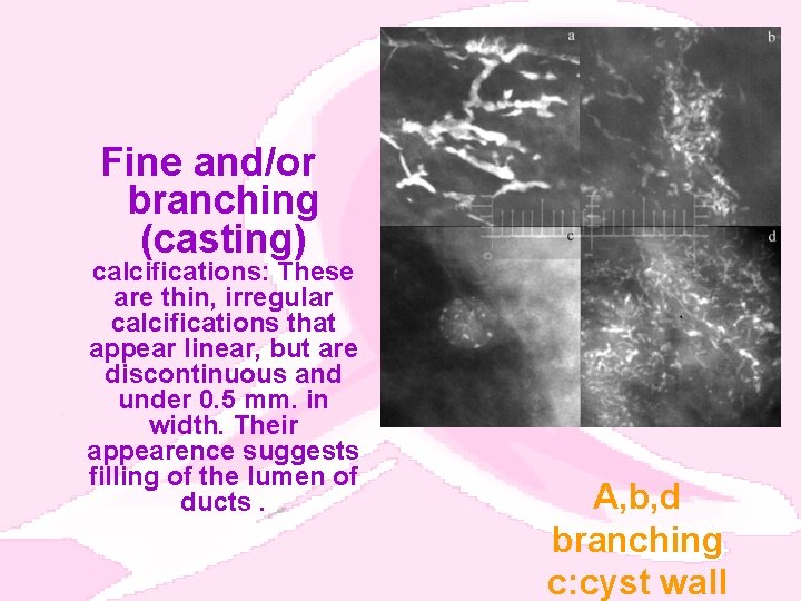 Fine and/or branching (casting) calcifications: These are thin, irregular calcifications that appear linear, but