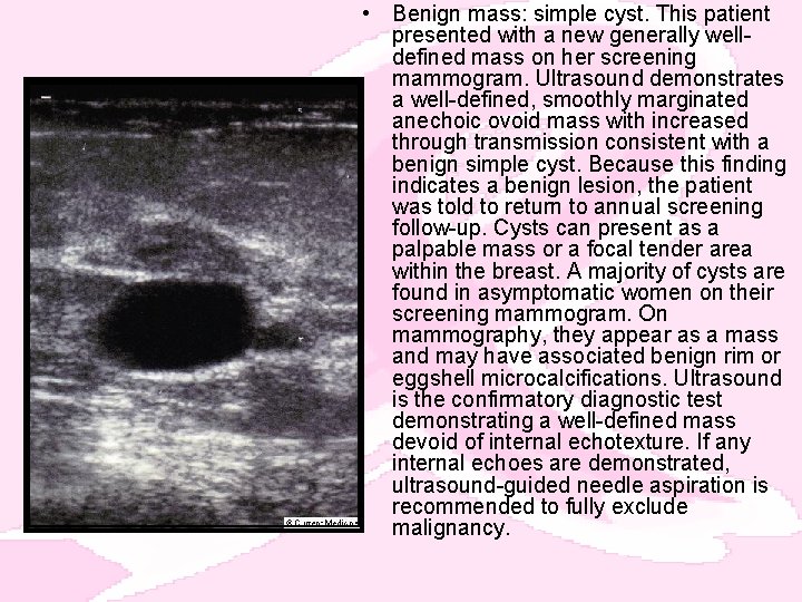  • Benign mass: simple cyst. This patient presented with a new generally welldefined