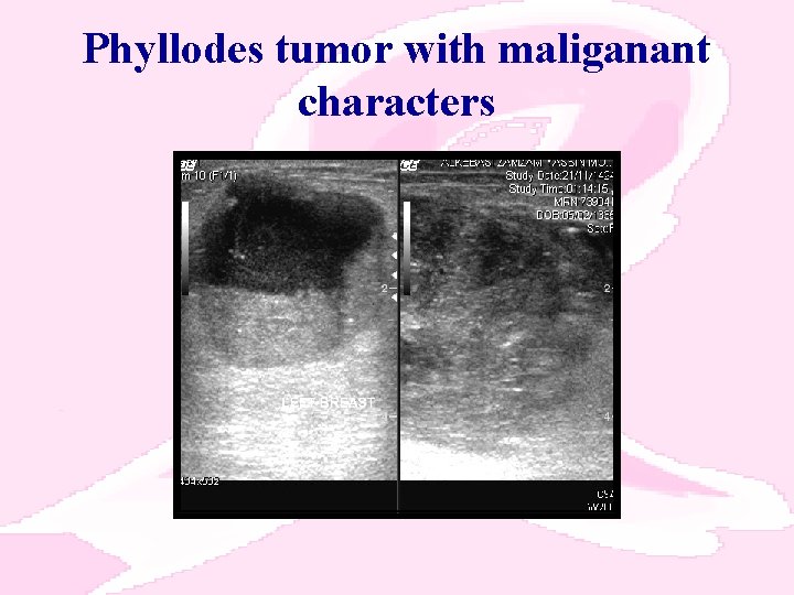 Phyllodes tumor with maliganant characters 