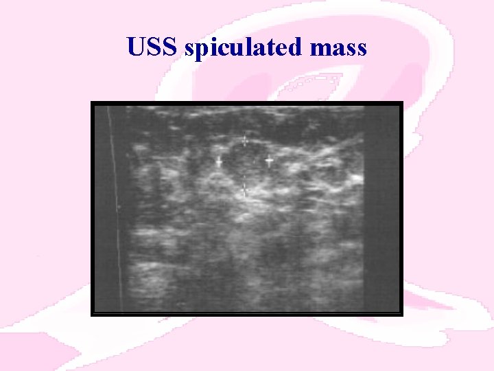 USS spiculated mass 