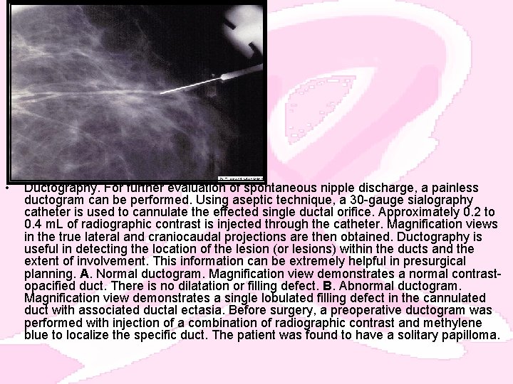  • Ductography. For further evaluation of spontaneous nipple discharge, a painless ductogram can