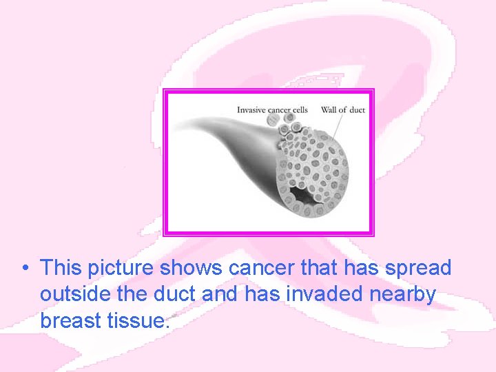 • This picture shows cancer that has spread outside the duct and has