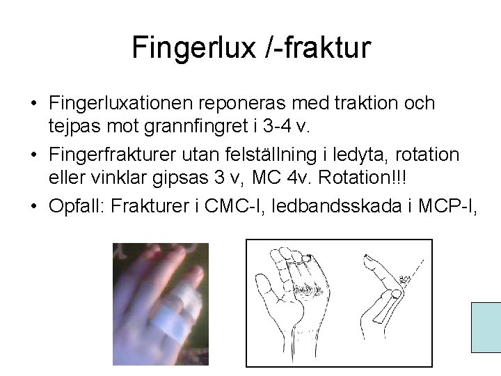 Fingerlux /-fraktur • Fingerluxationen reponeras med traktion och tejpas mot grannfingret i 3 -4