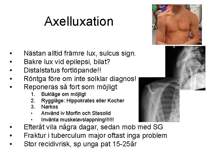 Axelluxation • • • Nästan alltid främre lux, sulcus sign. Bakre lux vid epilepsi,