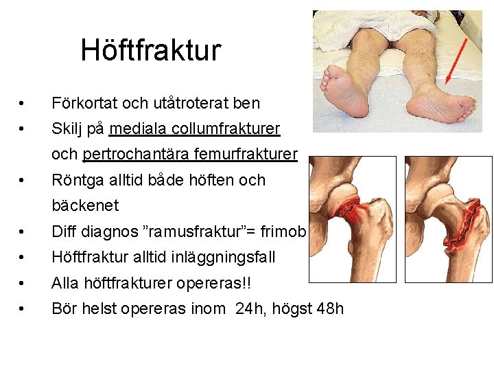 Höftfraktur • Förkortat och utåtroterat ben • Skilj på mediala collumfrakturer och pertrochantära femurfrakturer