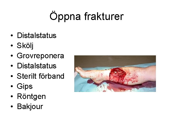 Öppna frakturer • • Distalstatus Skölj Grovreponera Distalstatus Sterilt förband Gips Röntgen Bakjour 