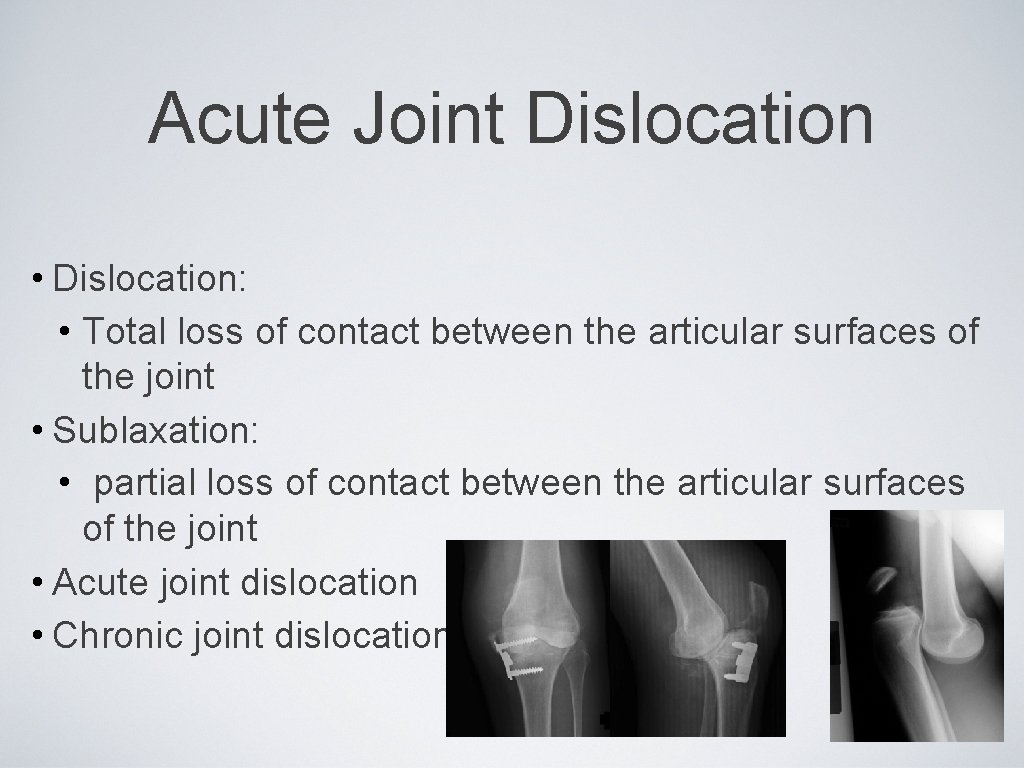 Acute Joint Dislocation • Dislocation: • Total loss of contact between the articular surfaces