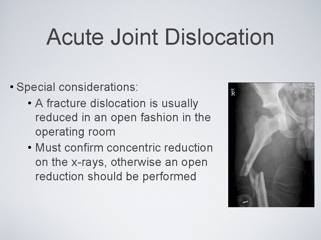 Acute Joint Dislocation • Special considerations: • A fracture dislocation is usually reduced in