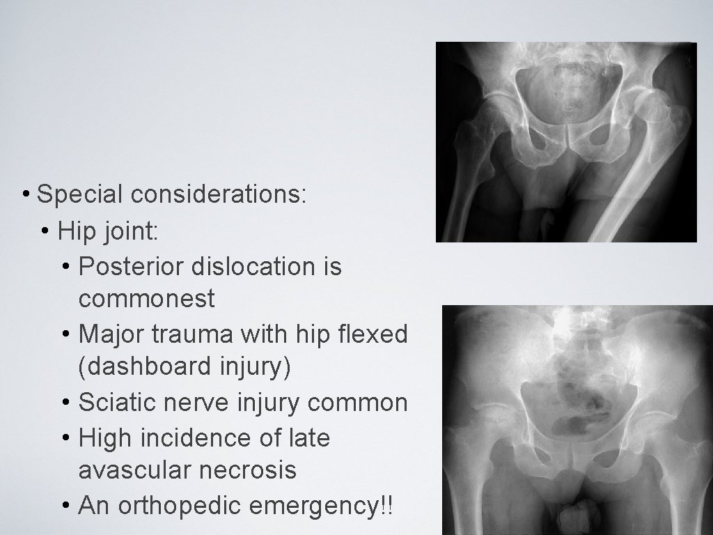 Acute Joint Dislocation • Special considerations: • Hip joint: • Posterior dislocation is commonest