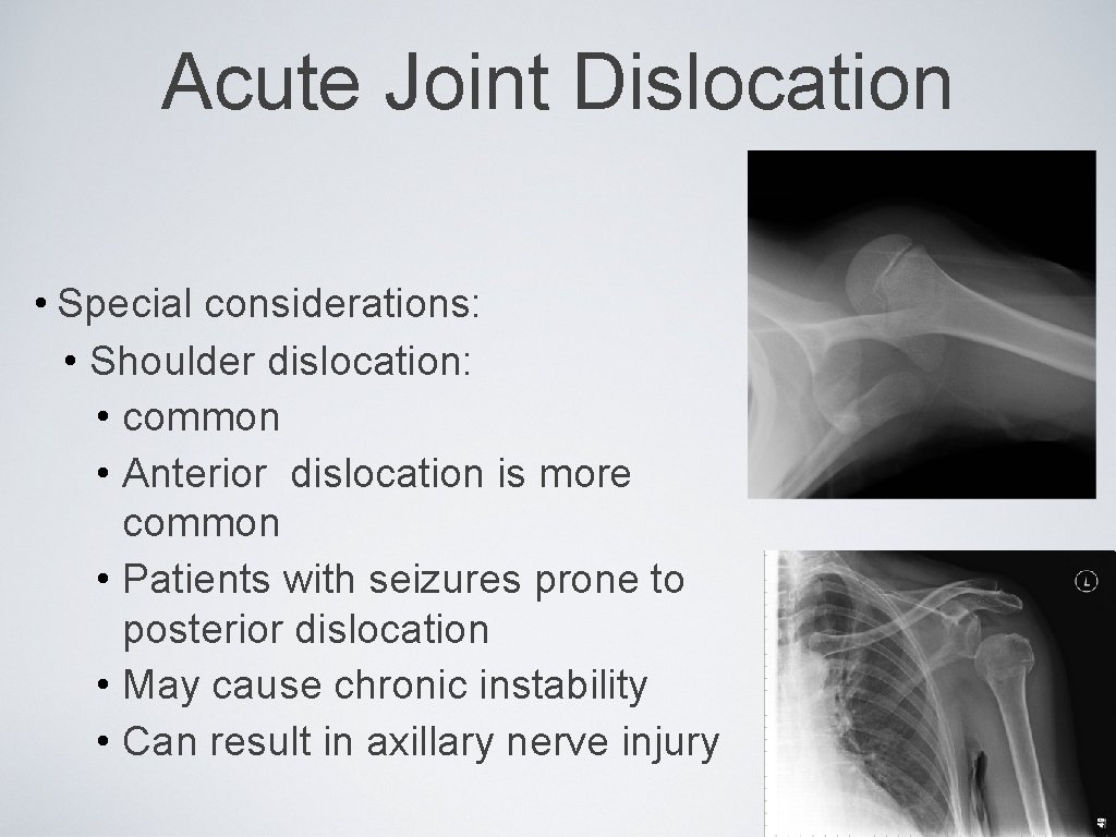 Acute Joint Dislocation • Special considerations: • Shoulder dislocation: • common • Anterior dislocation