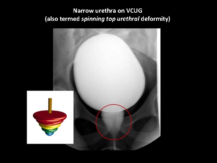 Narrow urethra on VCUG (also termed spinning top urethral deformity) 