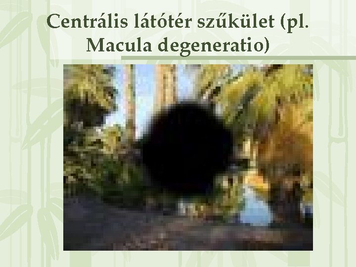 Centrális látótér szűkület (pl. Macula degeneratio) 
