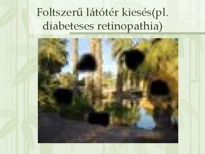 Foltszerű látótér kiesés(pl. diabeteses retinopathia) 