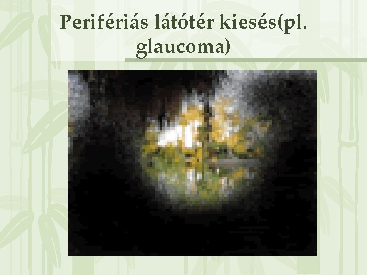 Perifériás látótér kiesés(pl. glaucoma) 