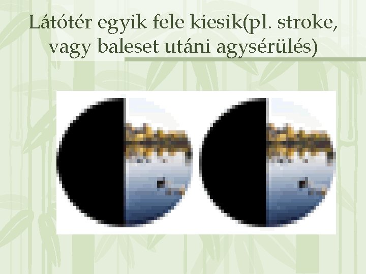 Látótér egyik fele kiesik(pl. stroke, vagy baleset utáni agysérülés) 