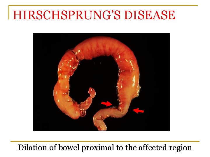 HIRSCHSPRUNG’S DISEASE Dilation of bowel proximal to the affected region 