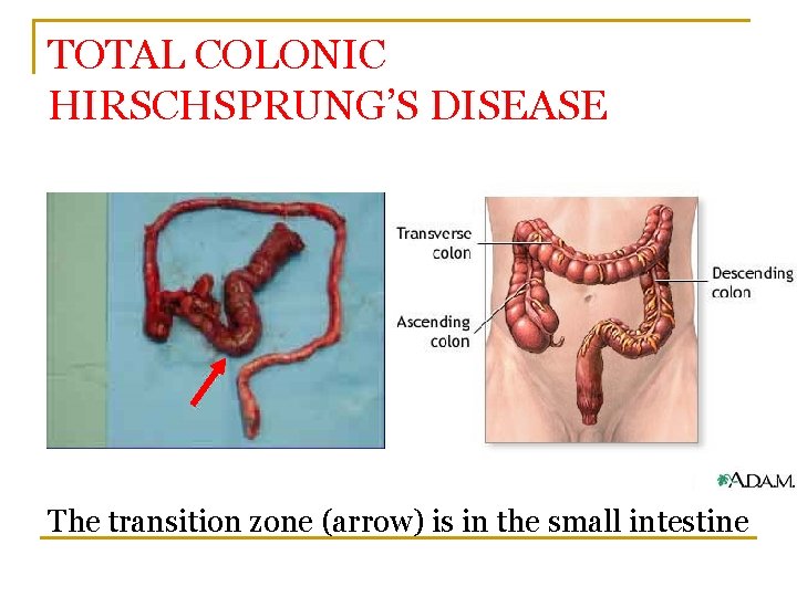 TOTAL COLONIC HIRSCHSPRUNG’S DISEASE The transition zone (arrow) is in the small intestine 