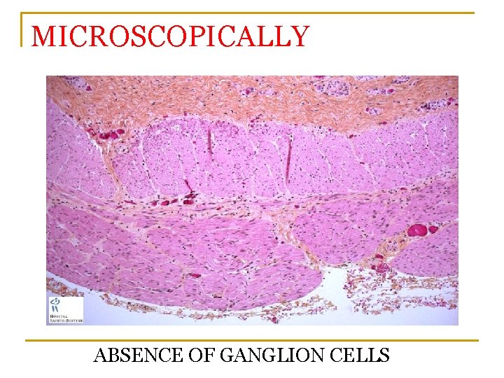 MICROSCOPICALLY ABSENCE OF GANGLION CELLS 