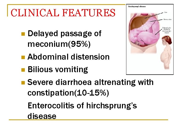 CLINICAL FEATURES Delayed passage of meconium(95%) n Abdominal distension n Bilious vomiting n Severe